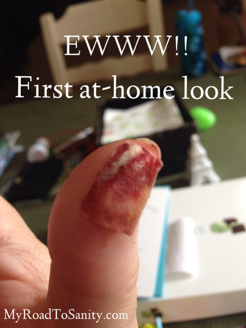 At home look at my thumb after mandolin slicer accident